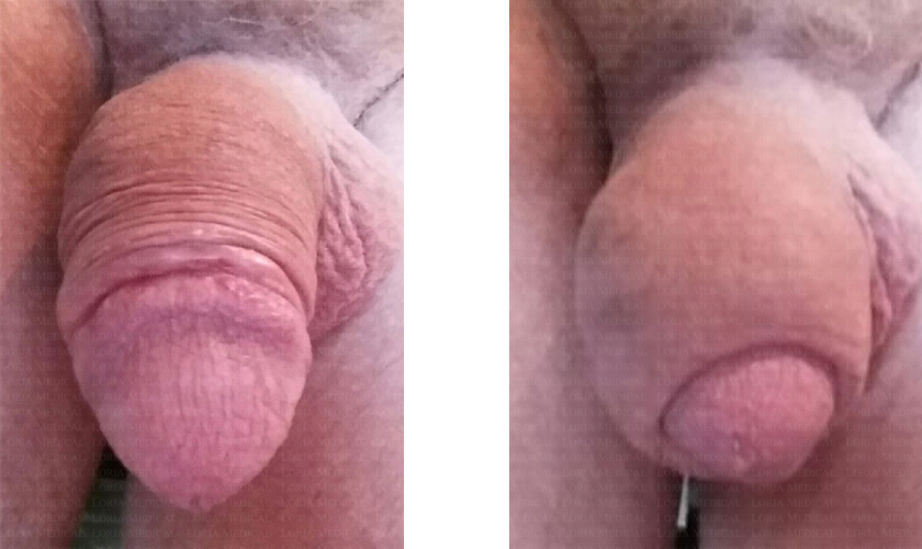 Permanent Non-Surgical Penis Enlargement arizona